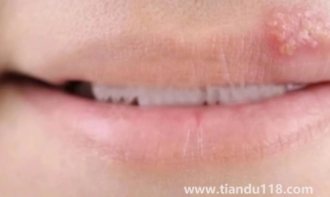 帶狀皰疹結(jié)痂后里面有膿咋辦(面部皰疹留下凹坑怎么去除)(圖3) 帶狀皰疹結(jié)痂后里面有膿咋辦3